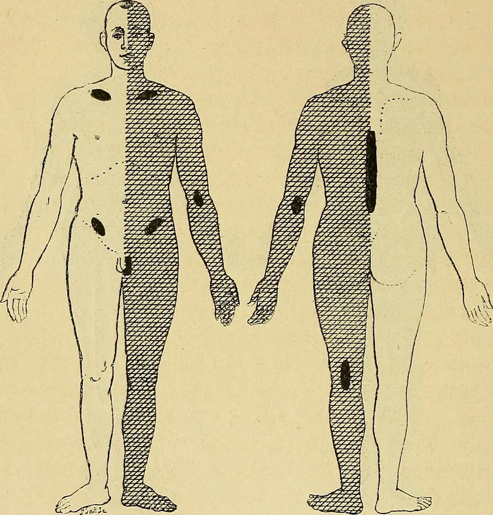 An illustration from Leçons cliniques sur l'hystérie et l'hypnotisme : faites à l'Hôpital Saint-André de Bordeaux, 1891, leaf 261