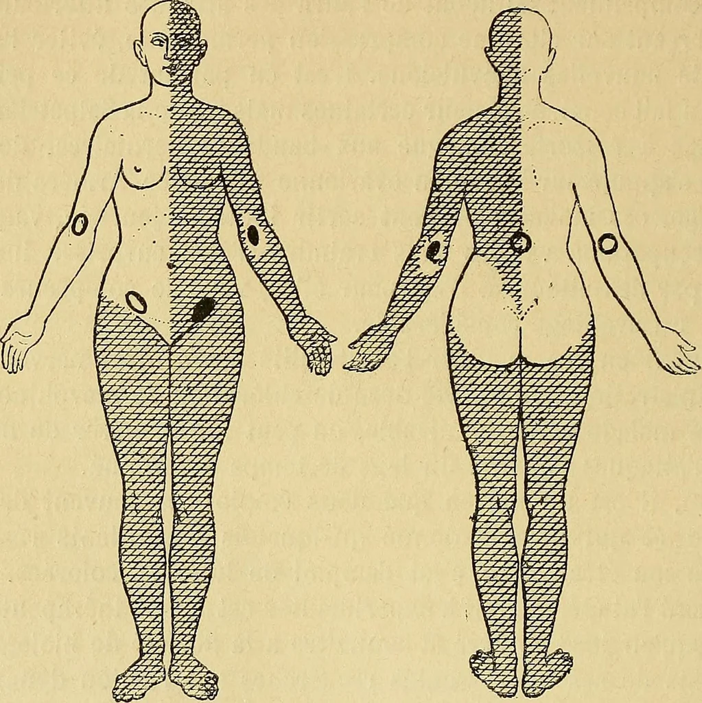 An illustration from Leçons cliniques sur l'hystérie et l'hypnotisme : faites à l'Hôpital Saint-André de Bordeaux, 1891, leaf 301