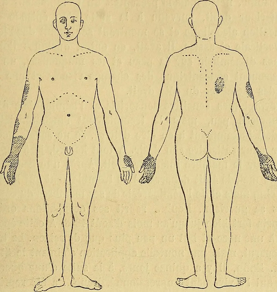 An illustration from Leçons cliniques sur l'hystérie et l'hypnotisme : faites à l'Hôpital Saint-André de Bordeaux, 1891, leaf 308