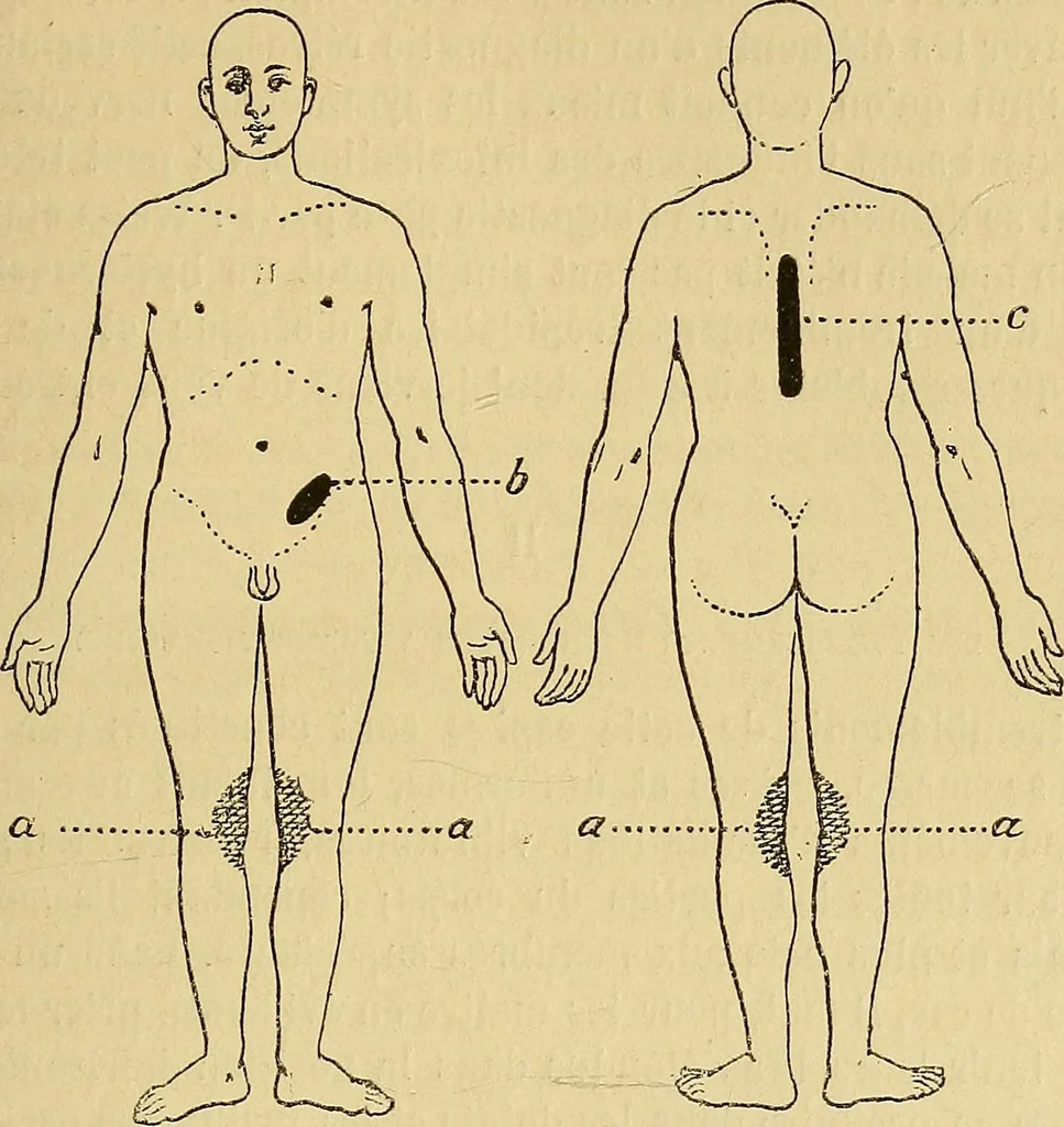 An illustration from Leçons cliniques sur l'hystérie et l'hypnotisme : faites à l'Hôpital Saint-André de Bordeaux, 1891, leaf 312