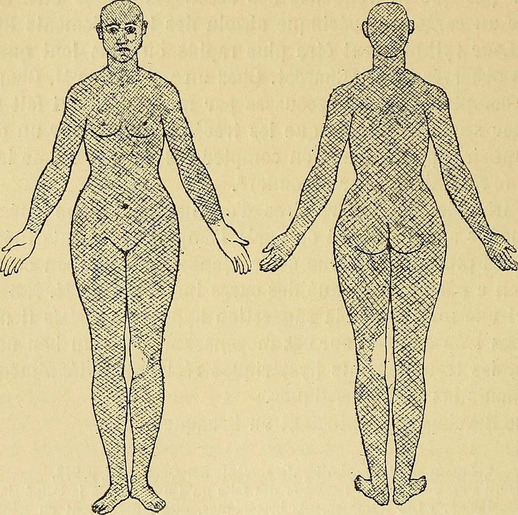 An illustration from Leçons cliniques sur l'hystérie et l'hypnotisme : faites à l'Hôpital Saint-André de Bordeaux, 1891, leaf 315