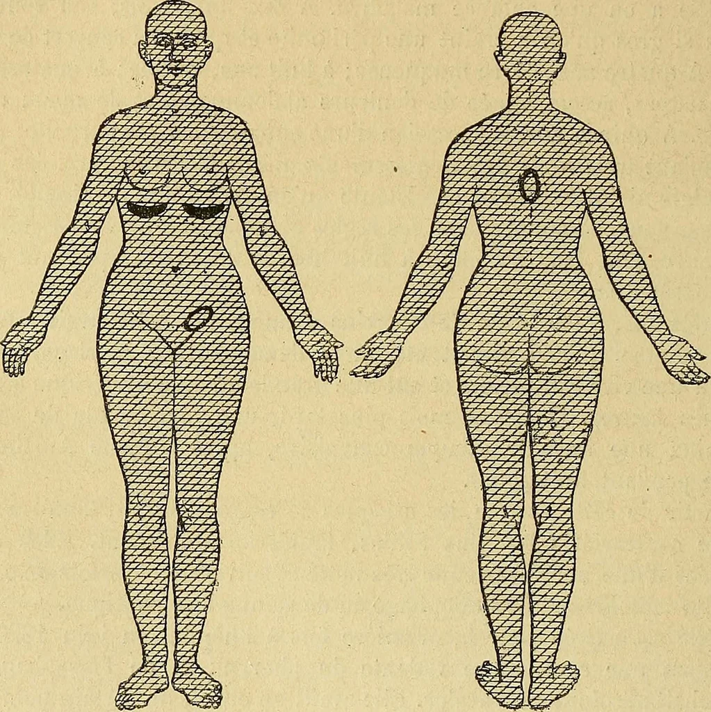 An illustration from Leçons cliniques sur l'hystérie et l'hypnotisme : faites à l'Hôpital Saint-André de Bordeaux, 1891, leaf 327
