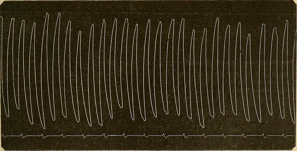 An illustration from Leçons cliniques sur l'hystérie et l'hypnotisme : faites à l'Hôpital Saint-André de Bordeaux, 1891, leaf 328
