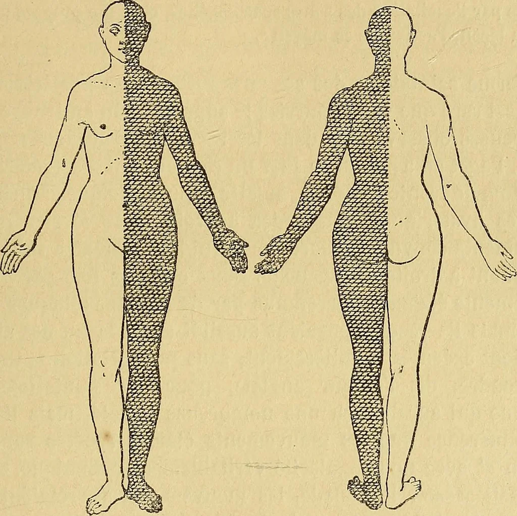 An illustration from Leçons cliniques sur l'hystérie et l'hypnotisme : faites à l'Hôpital Saint-André de Bordeaux, 1891, leaf 342