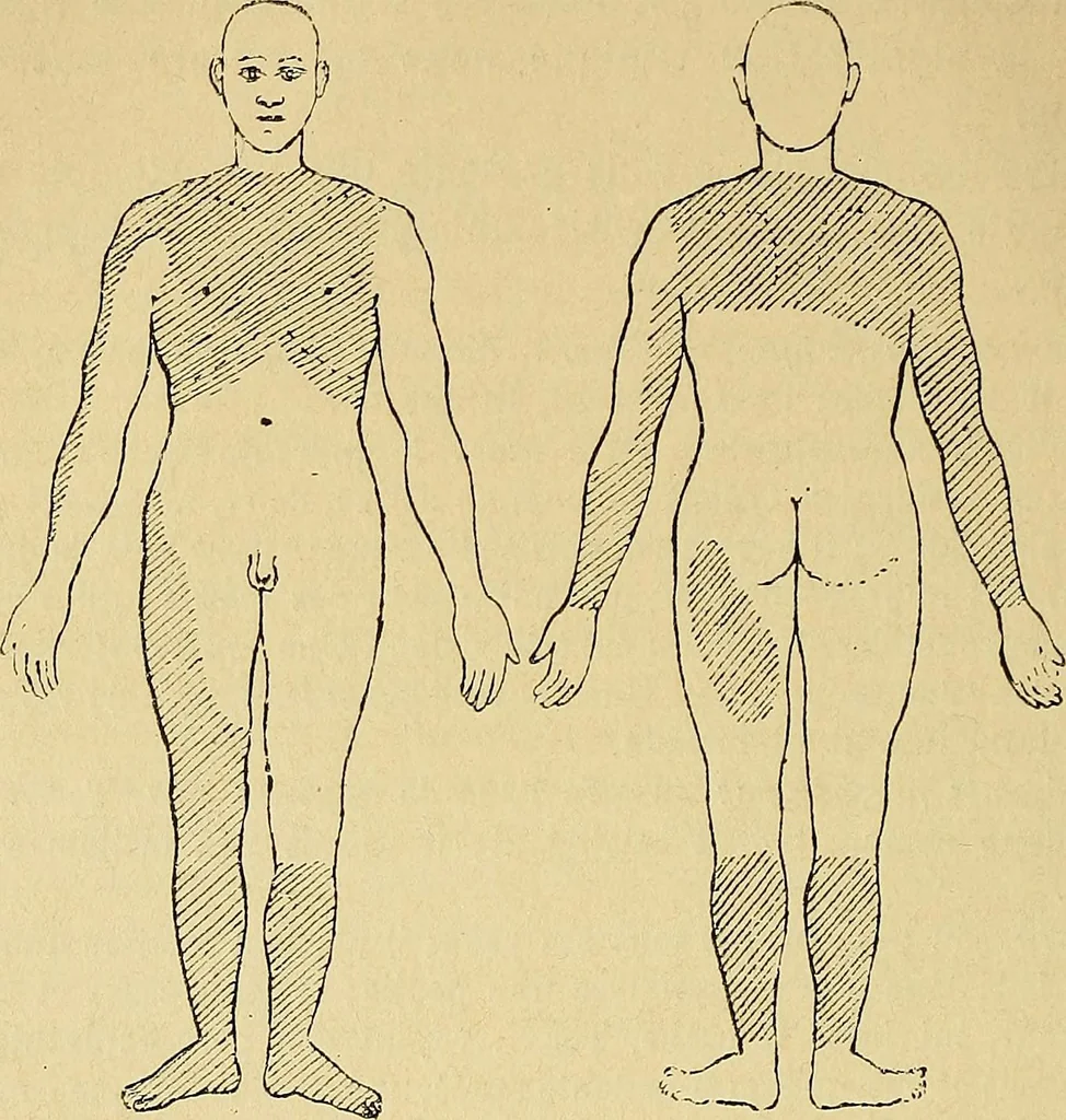 An illustration from Leçons cliniques sur l'hystérie et l'hypnotisme : faites à l'Hôpital Saint-André de Bordeaux, 1891, leaf 389