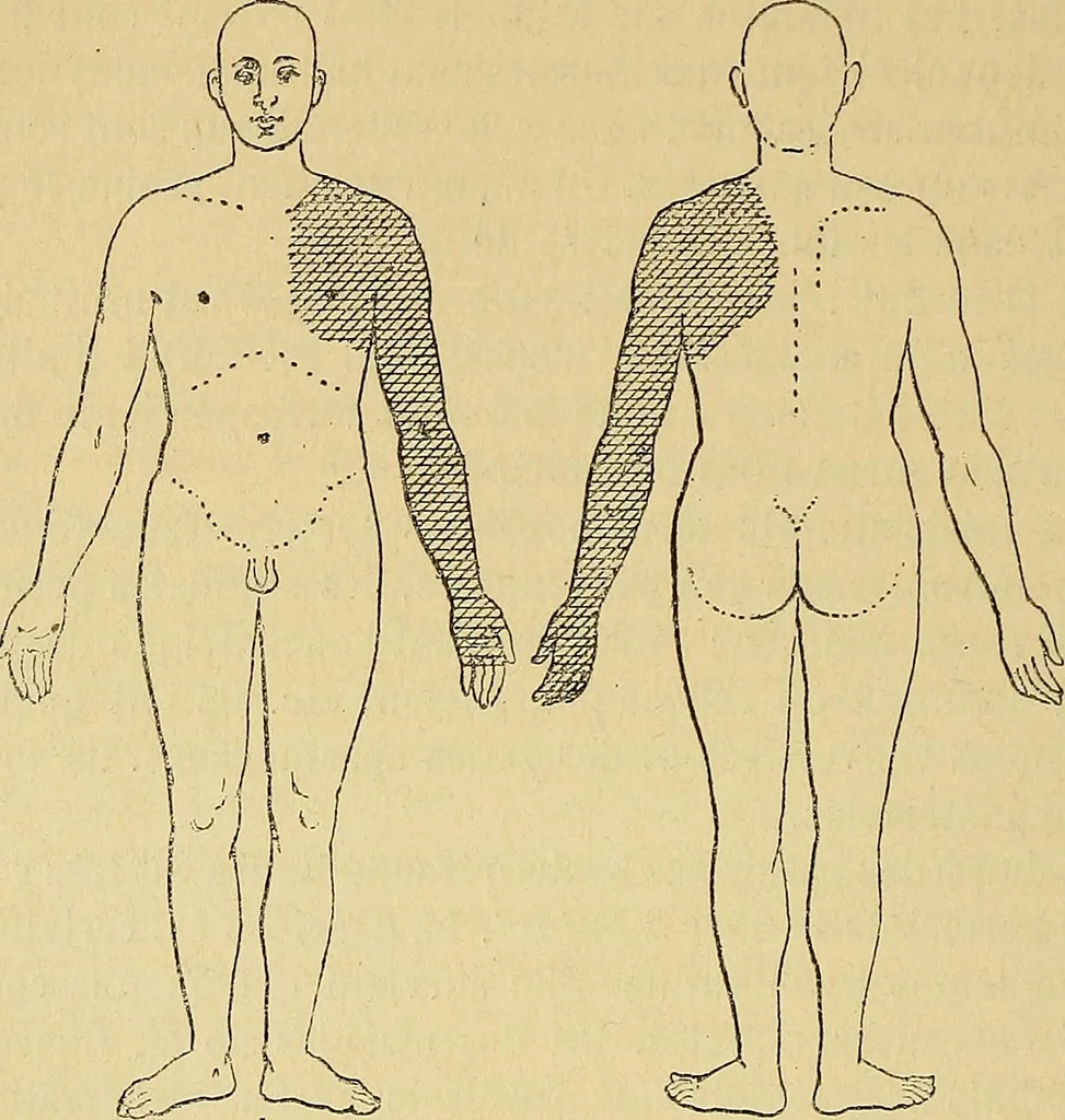 An illustration from Leçons cliniques sur l'hystérie et l'hypnotisme : faites à l'Hôpital Saint-André de Bordeaux, 1891, leaf 437