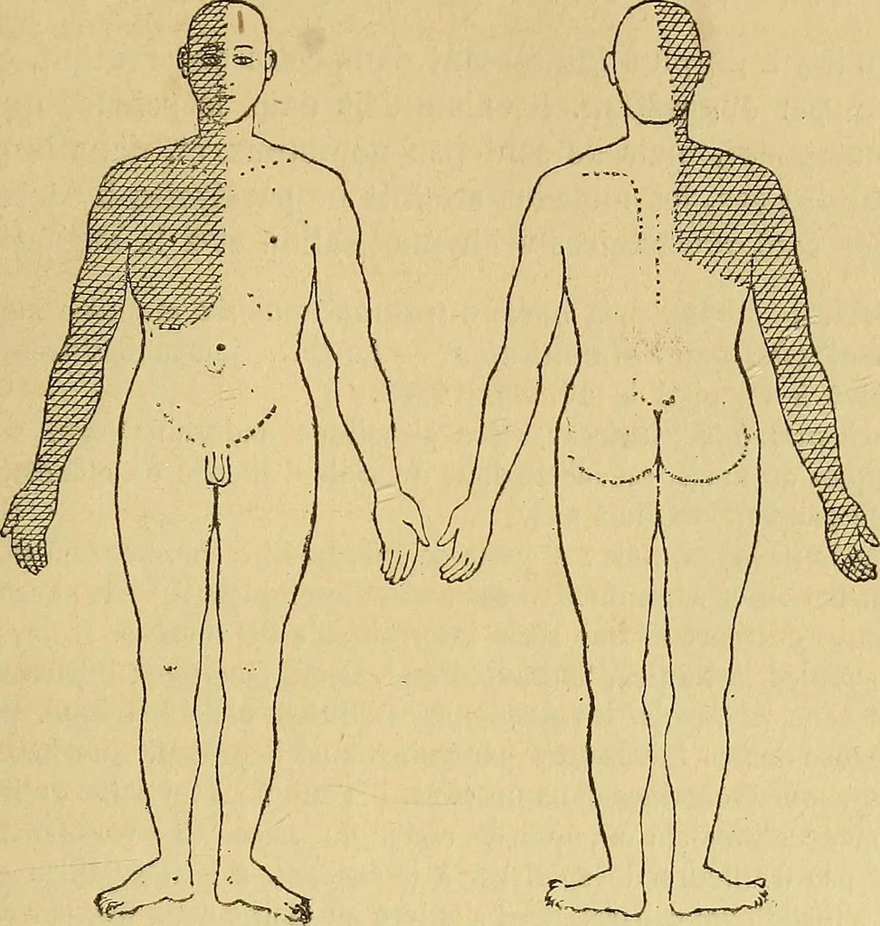 An illustration from Leçons cliniques sur l'hystérie et l'hypnotisme : faites à l'Hôpital Saint-André de Bordeaux, 1891, leaf 440