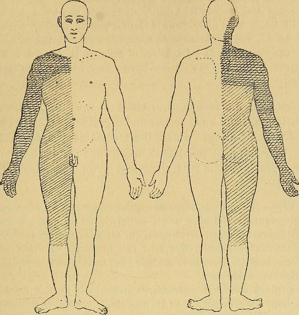 An illustration from Leçons cliniques sur l'hystérie et l'hypnotisme : faites à l'Hôpital Saint-André de Bordeaux, 1891, leaf 442
