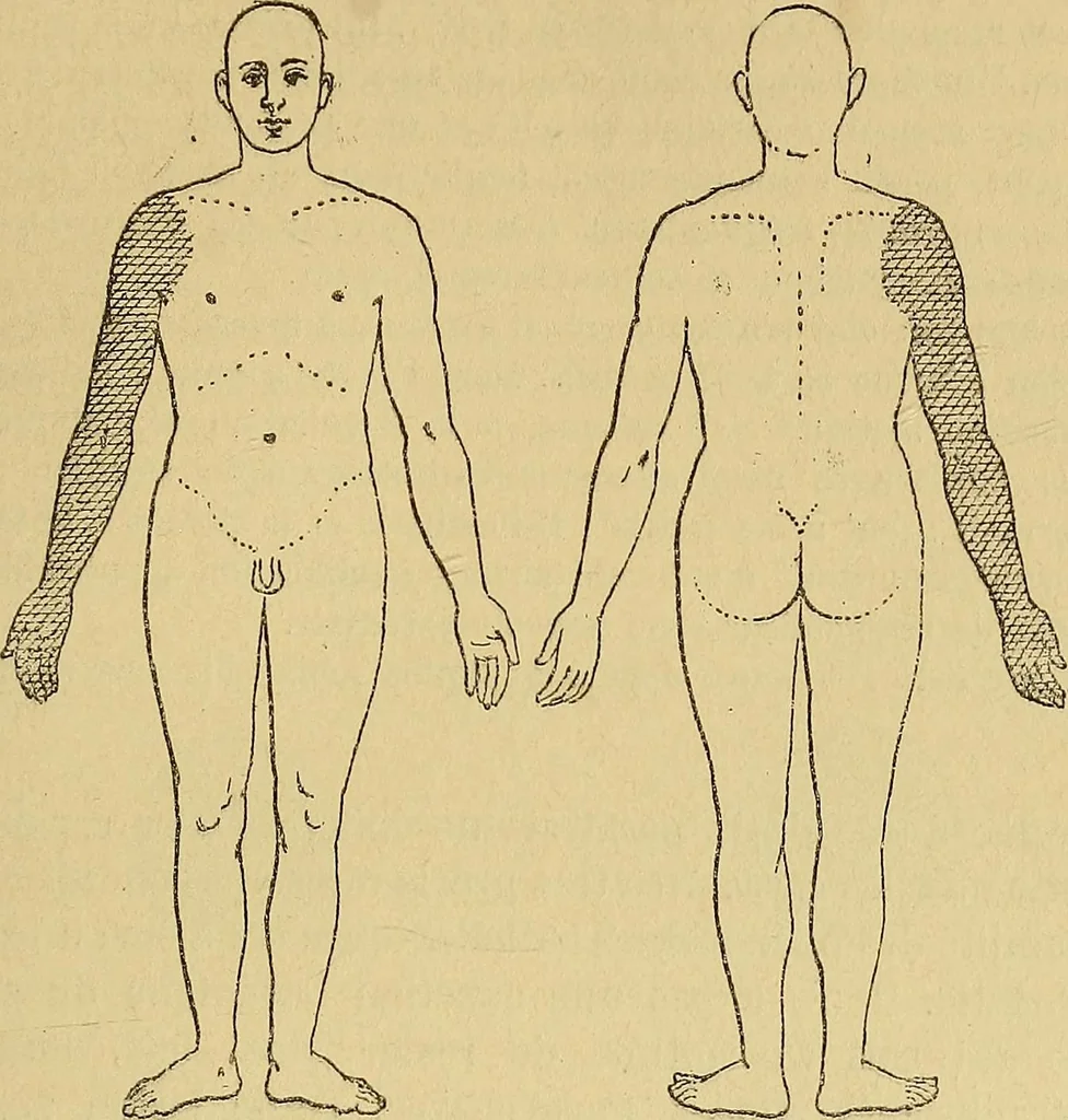 An illustration from Leçons cliniques sur l'hystérie et l'hypnotisme : faites à l'Hôpital Saint-André de Bordeaux, 1891, leaf 444
