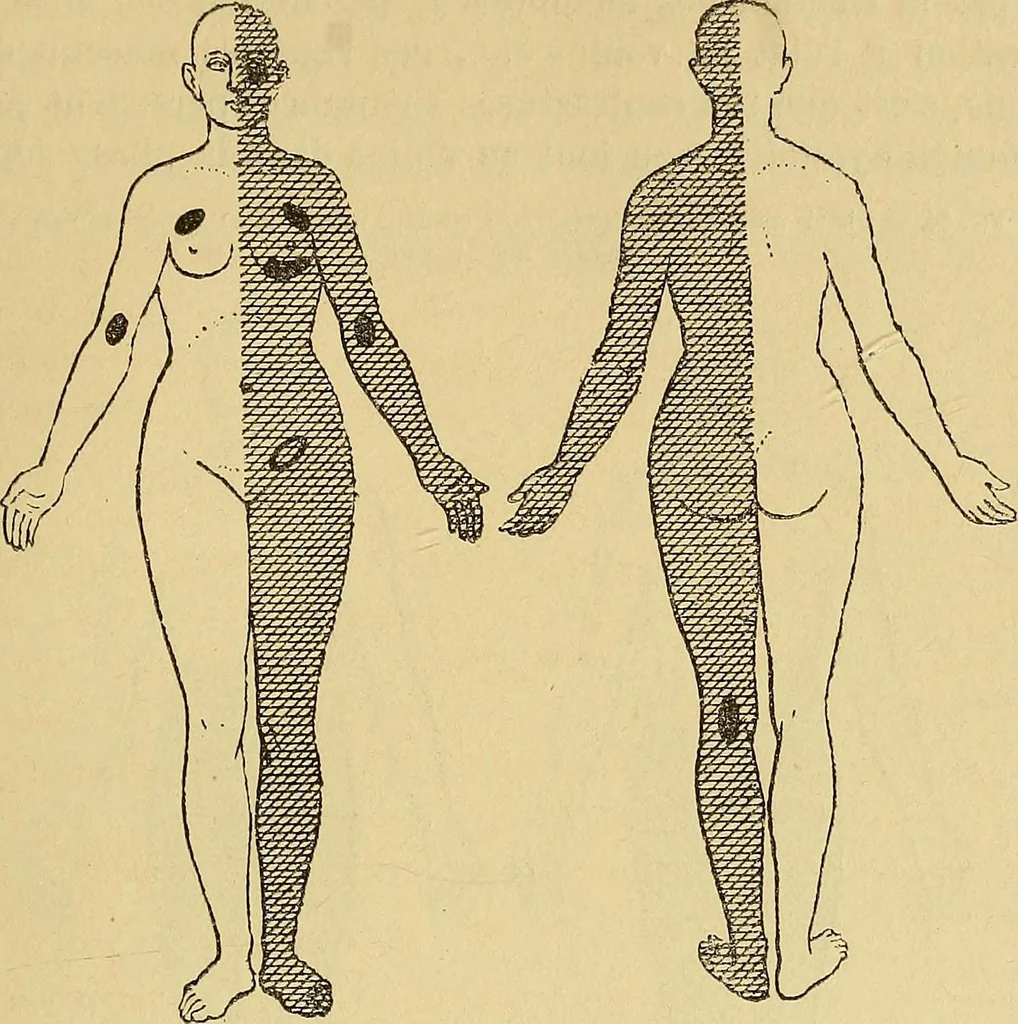 An illustration from Leçons cliniques sur l'hystérie et l'hypnotisme : faites à l'Hôpital Saint-André de Bordeaux, 1891, leaf 468