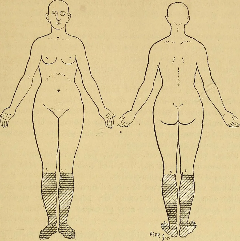 An illustration from Leçons cliniques sur l'hystérie et l'hypnotisme : faites à l'Hôpital Saint-André de Bordeaux, 1891, leaf 504