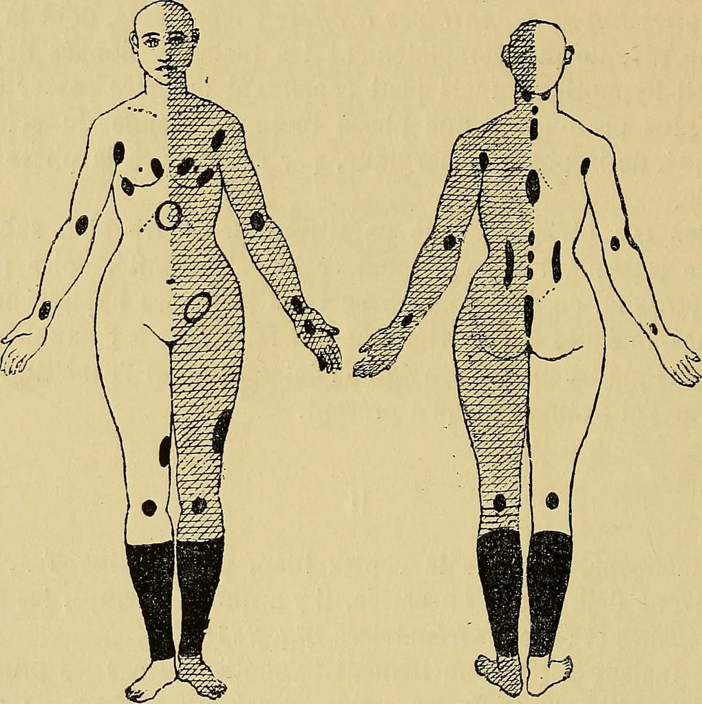 An illustration from Leçons cliniques sur l'hystérie et l'hypnotisme : faites à l'Hôpital Saint-André de Bordeaux, 1891, leaf 111