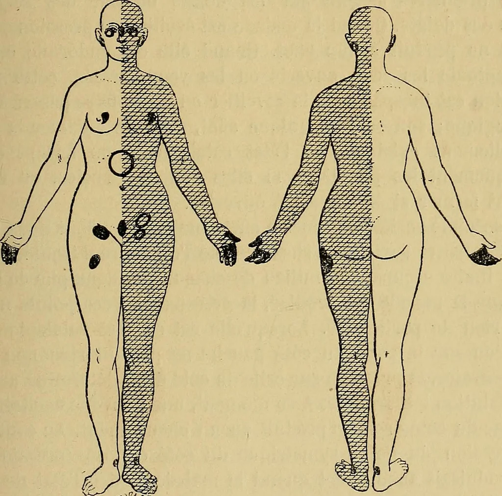 An illustration from Leçons cliniques sur l'hystérie et l'hypnotisme : faites à l'Hôpital Saint-André de Bordeaux, 1891, leaf 112