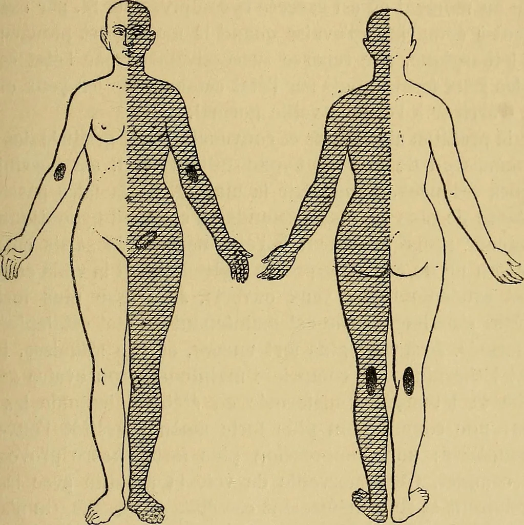 An illustration from Leçons cliniques sur l'hystérie et l'hypnotisme : faites à l'Hôpital Saint-André de Bordeaux, 1891, leaf 118