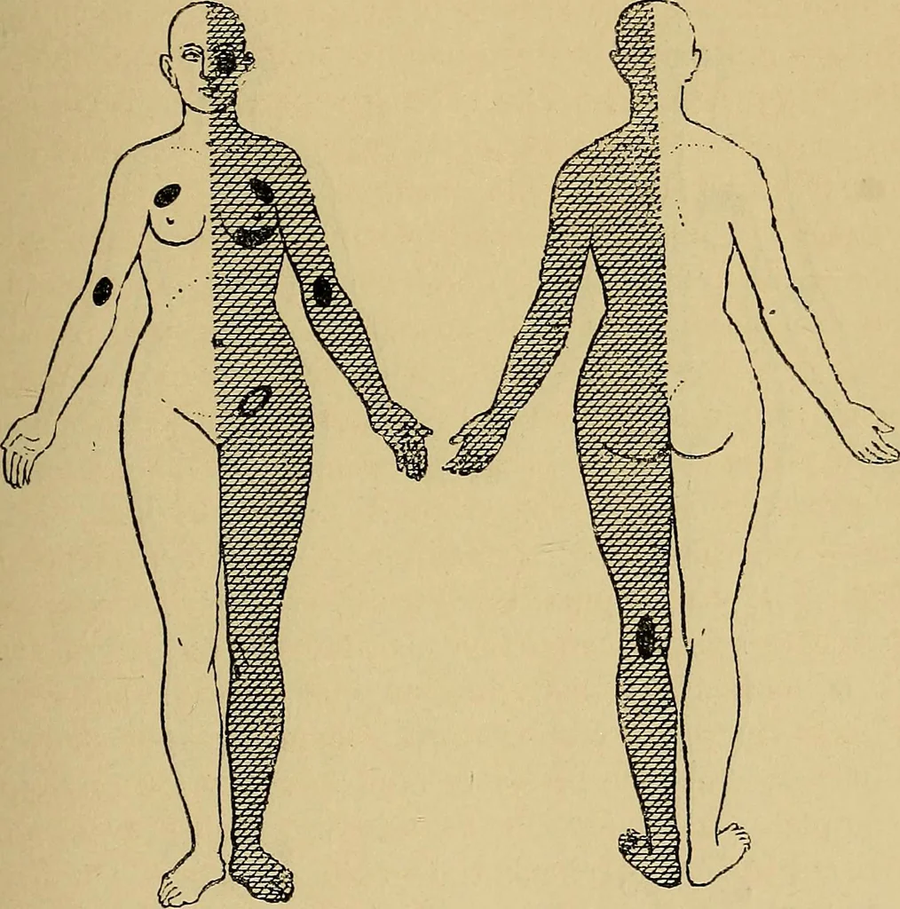 An illustration from Leçons cliniques sur l'hystérie et l'hypnotisme : faites à l'Hôpital Saint-André de Bordeaux, 1891, leaf 120