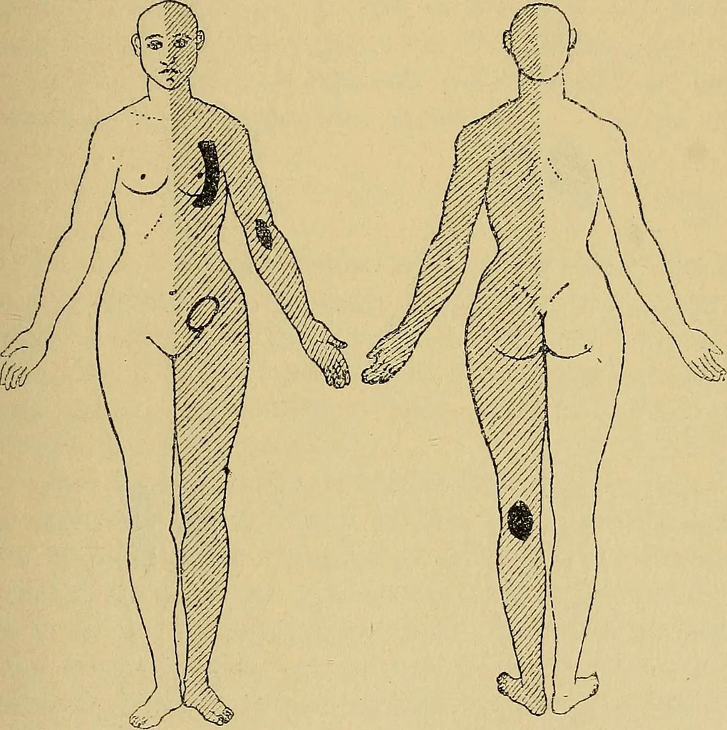 An illustration from Leçons cliniques sur l'hystérie et l'hypnotisme : faites à l'Hôpital Saint-André de Bordeaux, 1891, leaf 122