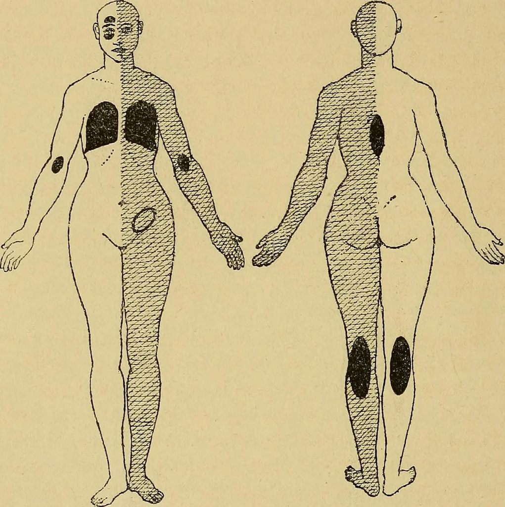 An illustration from Leçons cliniques sur l'hystérie et l'hypnotisme : faites à l'Hôpital Saint-André de Bordeaux, 1891, leaf 123