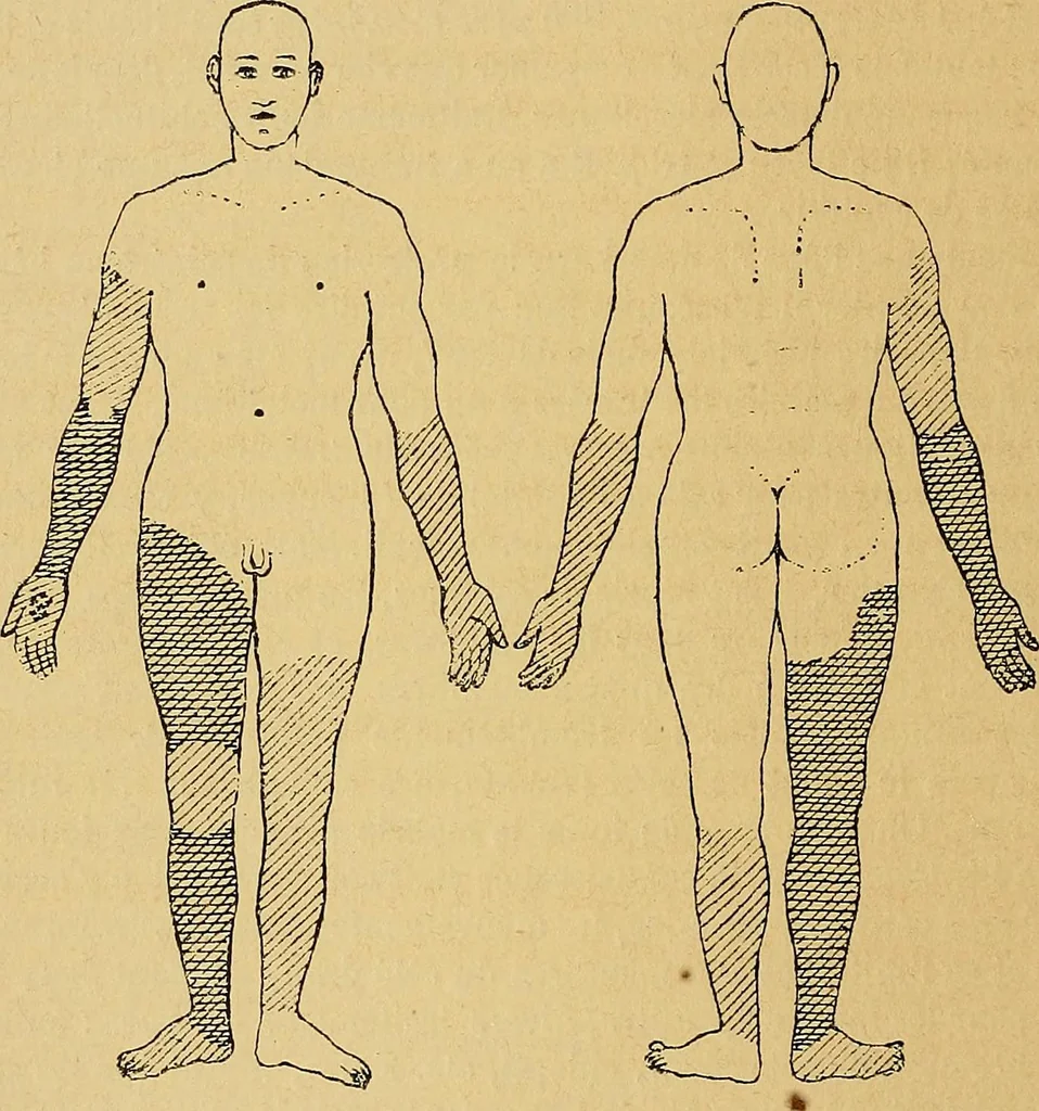 An illustration from Leçons cliniques sur l'hystérie et l'hypnotisme : faites à l'Hôpital Saint-André de Bordeaux, 1891, leaf 13