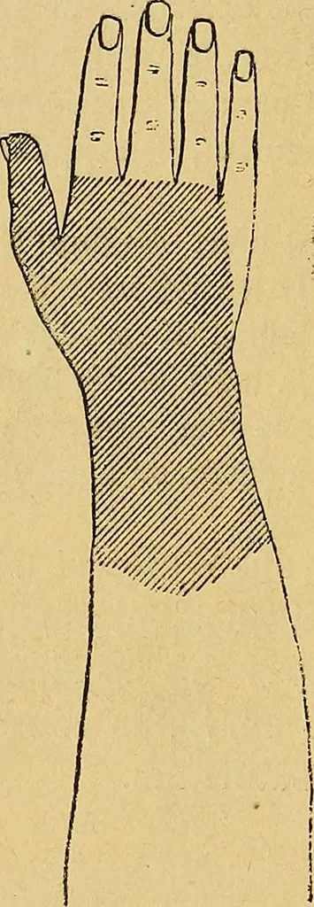 An illustration from Leçons cliniques sur l'hystérie et l'hypnotisme : faites à l'Hôpital Saint-André de Bordeaux, 1891, leaf 15