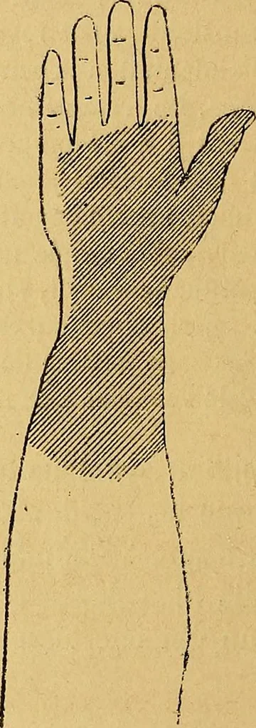 An illustration from Leçons cliniques sur l'hystérie et l'hypnotisme : faites à l'Hôpital Saint-André de Bordeaux, 1891, leaf 15