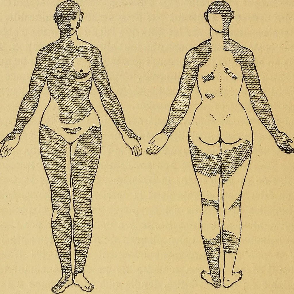 An illustration from Leçons cliniques sur l'hystérie et l'hypnotisme : faites à l'Hôpital Saint-André de Bordeaux, 1891, leaf 23