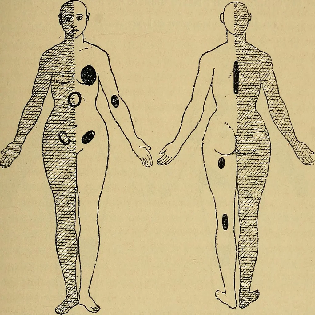 An illustration from Leçons cliniques sur l'hystérie et l'hypnotisme : faites à l'Hôpital Saint-André de Bordeaux, 1891, leaf 334