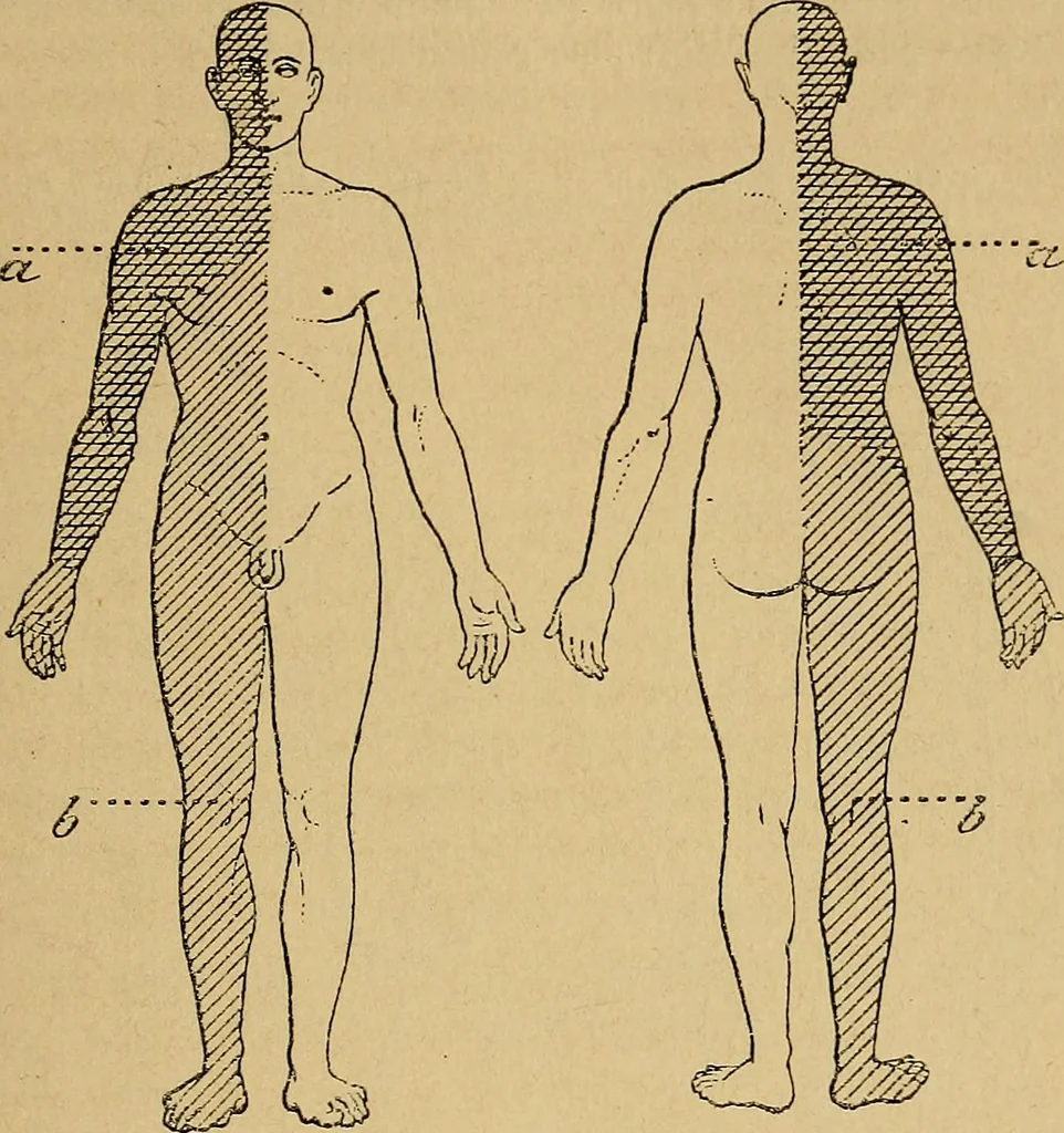 An illustration from Leçons cliniques sur l'hystérie et l'hypnotisme : faites à l'Hôpital Saint-André de Bordeaux, 1891, leaf 34