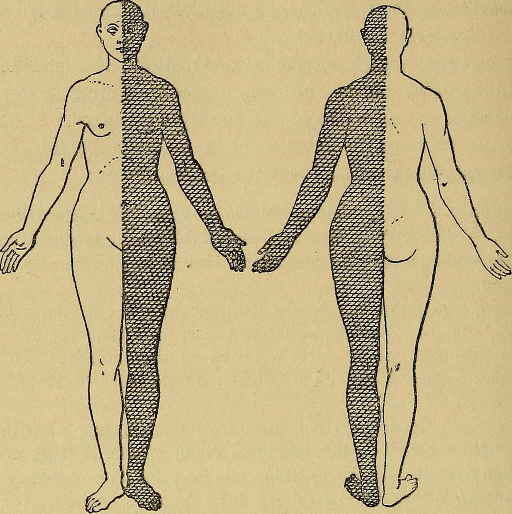 An illustration from Leçons cliniques sur l'hystérie et l'hypnotisme : faites à l'Hôpital Saint-André de Bordeaux, 1891, leaf 359