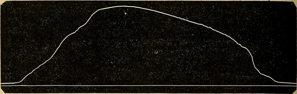An illustration from Leçons cliniques sur l'hystérie et l'hypnotisme : faites à l'Hôpital Saint-André de Bordeaux, 1891, leaf 361