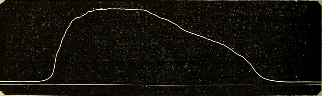 An illustration from Leçons cliniques sur l'hystérie et l'hypnotisme : faites à l'Hôpital Saint-André de Bordeaux, 1891, leaf 361