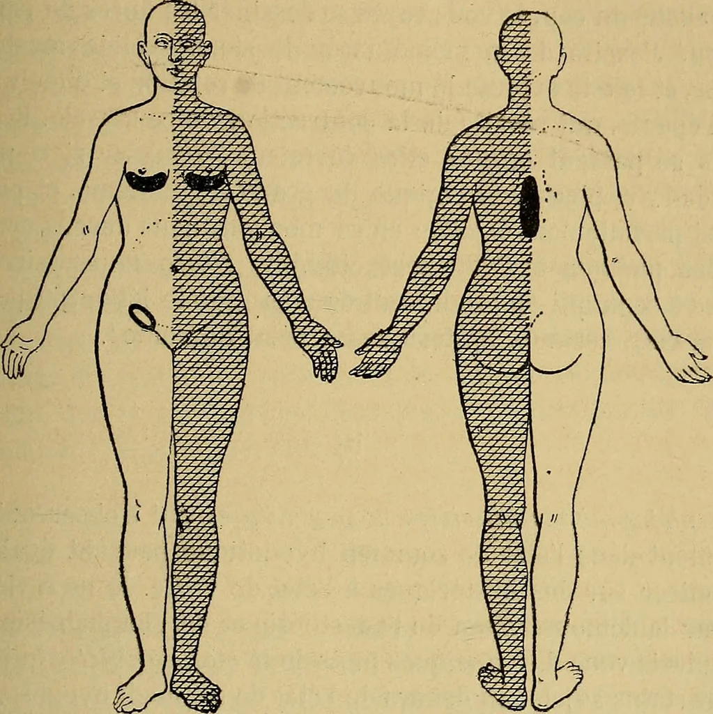 An illustration from Leçons cliniques sur l'hystérie et l'hypnotisme : faites à l'Hôpital Saint-André de Bordeaux, 1891, leaf 364
