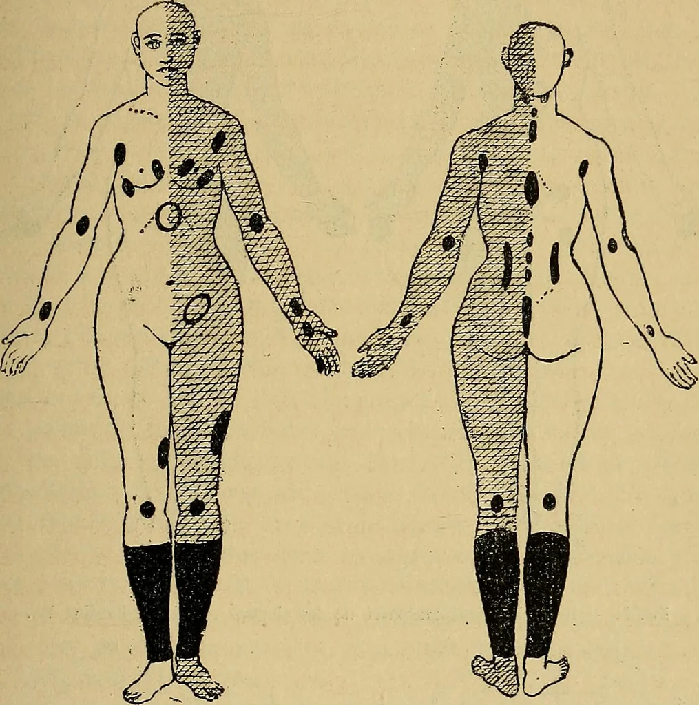 An illustration from Leçons cliniques sur l'hystérie et l'hypnotisme : faites à l'Hôpital Saint-André de Bordeaux, 1891, leaf 376