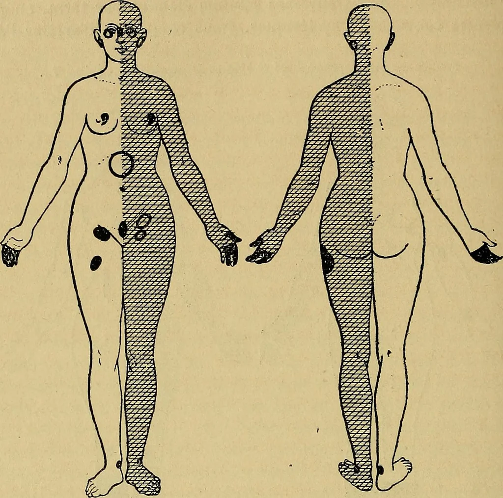 An illustration from Leçons cliniques sur l'hystérie et l'hypnotisme : faites à l'Hôpital Saint-André de Bordeaux, 1891, leaf 377