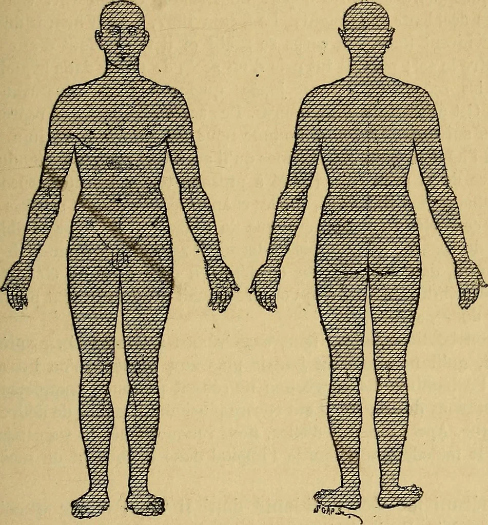 An illustration from Leçons cliniques sur l'hystérie et l'hypnotisme : faites à l'Hôpital Saint-André de Bordeaux, 1891, leaf 380