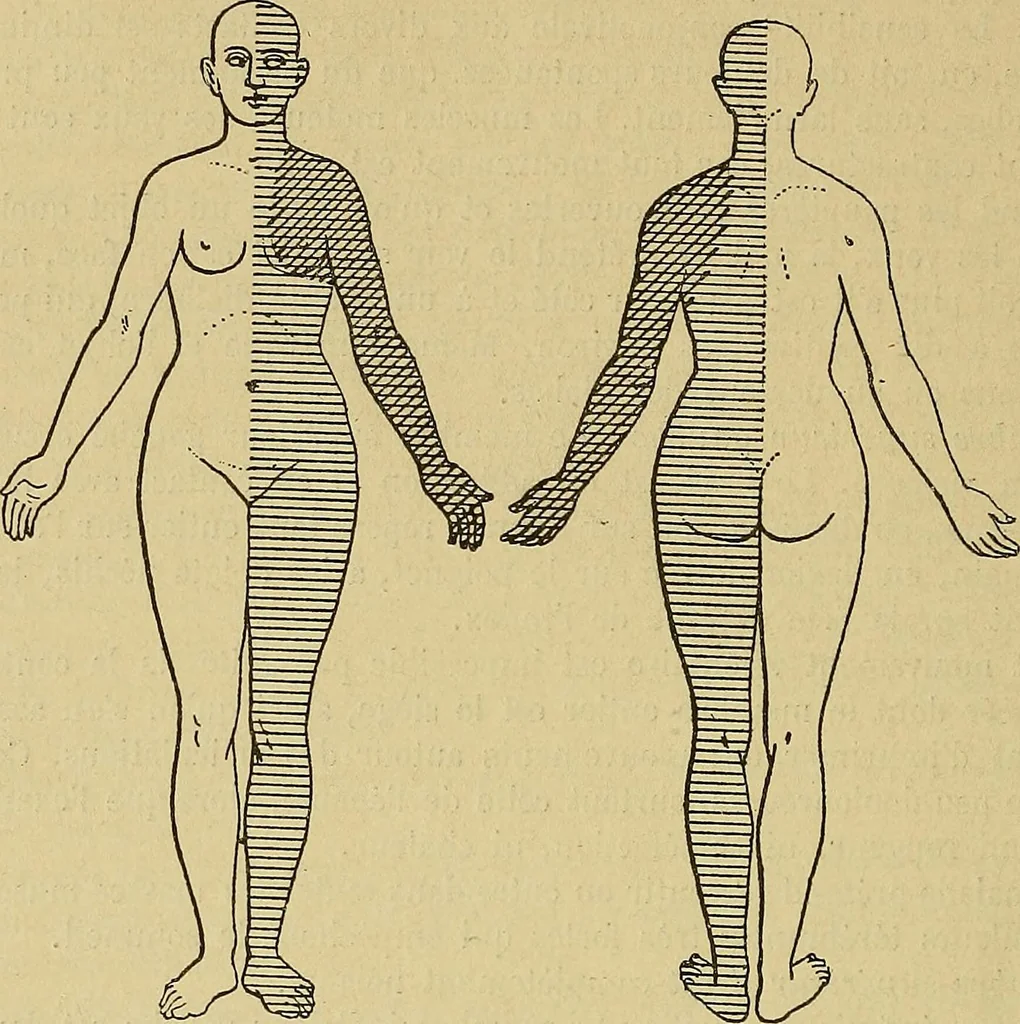 An illustration from Leçons cliniques sur l'hystérie et l'hypnotisme : faites à l'Hôpital Saint-André de Bordeaux, 1891, leaf 417