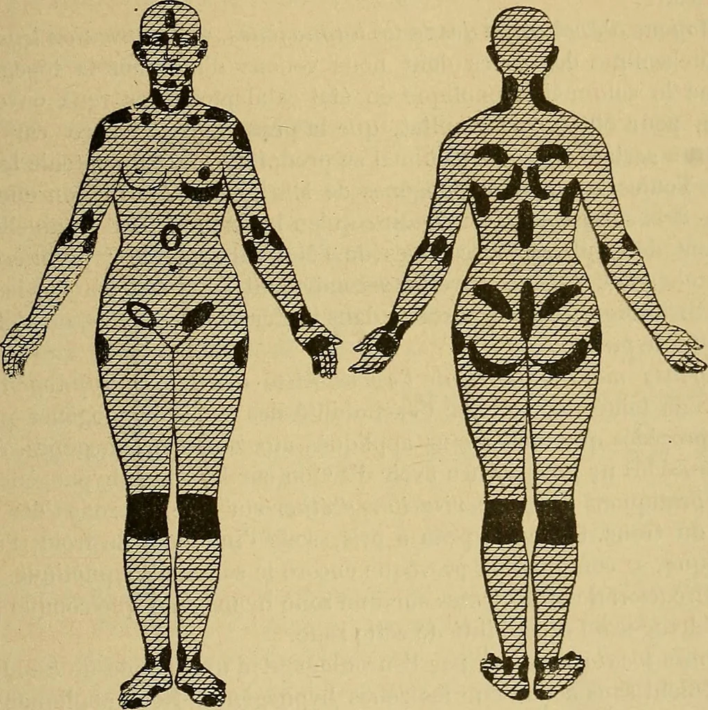An illustration from Leçons cliniques sur l'hystérie et l'hypnotisme : faites à l'Hôpital Saint-André de Bordeaux, 1891, leaf 466