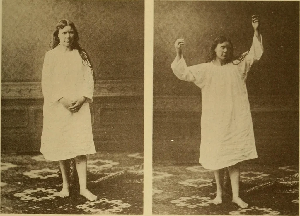 An illustration from Leçons cliniques sur l'hystérie et l'hypnotisme : faites à l'Hôpital Saint-André de Bordeaux, 1891, leaf 526
