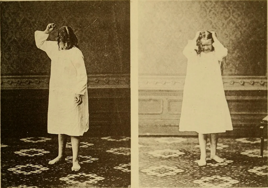 An illustration from Leçons cliniques sur l'hystérie et l'hypnotisme : faites à l'Hôpital Saint-André de Bordeaux, 1891, leaf 530
