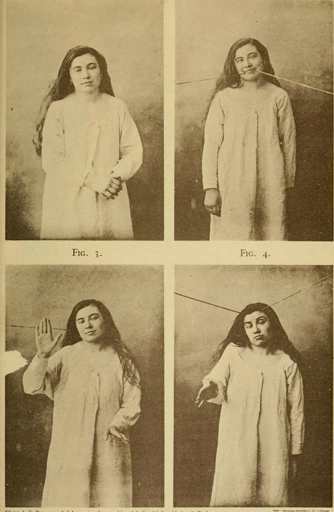 An illustration from Leçons cliniques sur l'hystérie et l'hypnotisme : faites à l'Hôpital Saint-André de Bordeaux, 1891, leaf 534