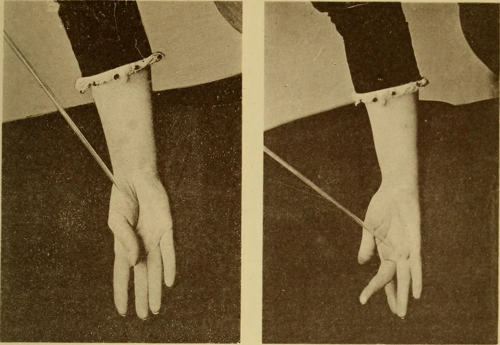 An illustration from Leçons cliniques sur l'hystérie et l'hypnotisme : faites à l'Hôpital Saint-André de Bordeaux, 1891, leaf 540