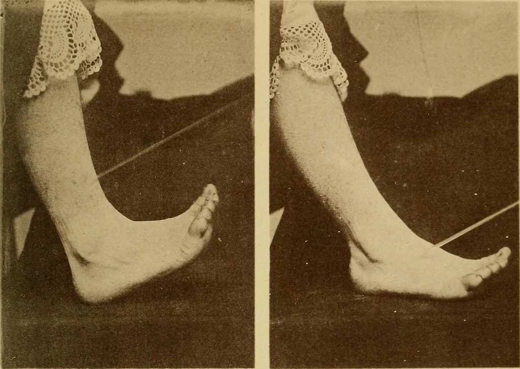 An illustration from Leçons cliniques sur l'hystérie et l'hypnotisme : faites à l'Hôpital Saint-André de Bordeaux, 1891, leaf 542