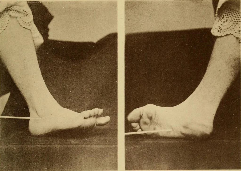 An illustration from Leçons cliniques sur l'hystérie et l'hypnotisme : faites à l'Hôpital Saint-André de Bordeaux, 1891, leaf 542