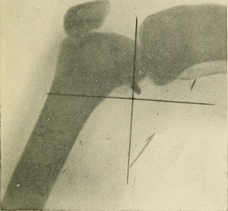 An illustration from Localization by X-rays and stereoscopy, 1916, leaf 120