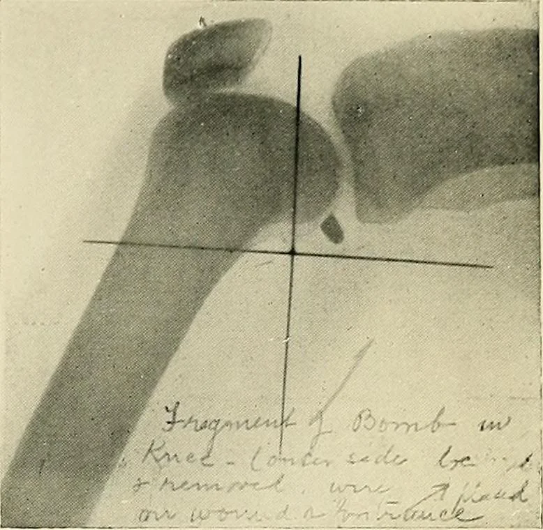 An illustration from Localization by X-rays and stereoscopy, 1916, leaf 120