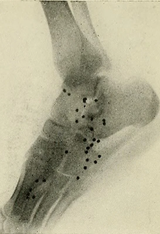 An illustration from Localization by X-rays and stereoscopy, 1916, leaf 122