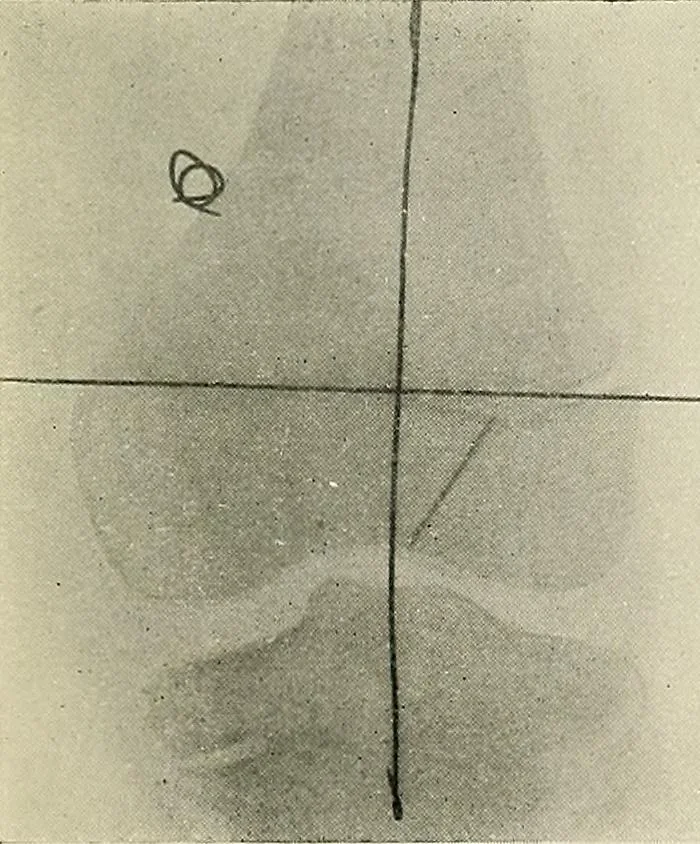 An illustration from Localization by X-rays and stereoscopy, 1916, leaf 122