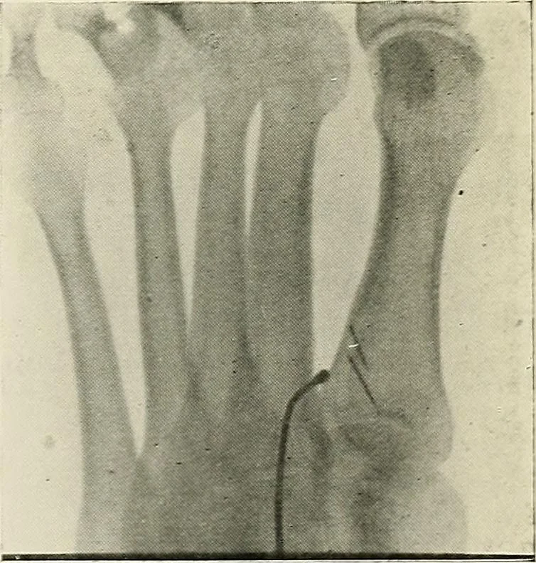 An illustration from Localization by X-rays and stereoscopy, 1916, leaf 124