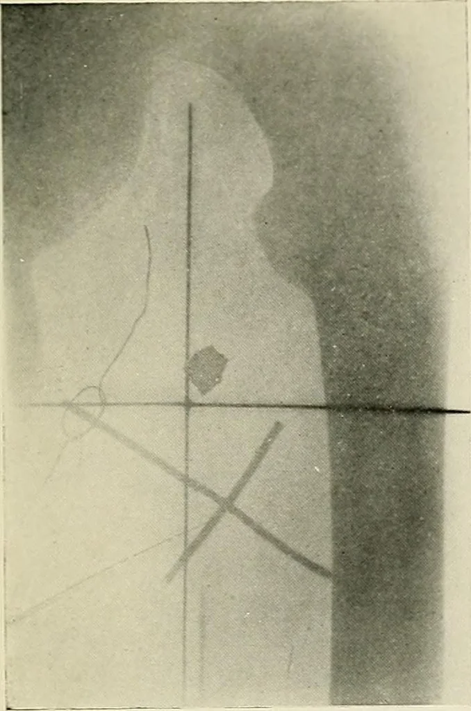 An illustration from Localization by X-rays and stereoscopy, 1916, leaf 126