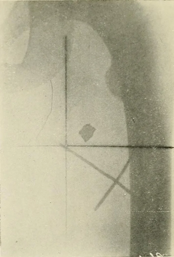 An illustration from Localization by X-rays and stereoscopy, 1916, leaf 126