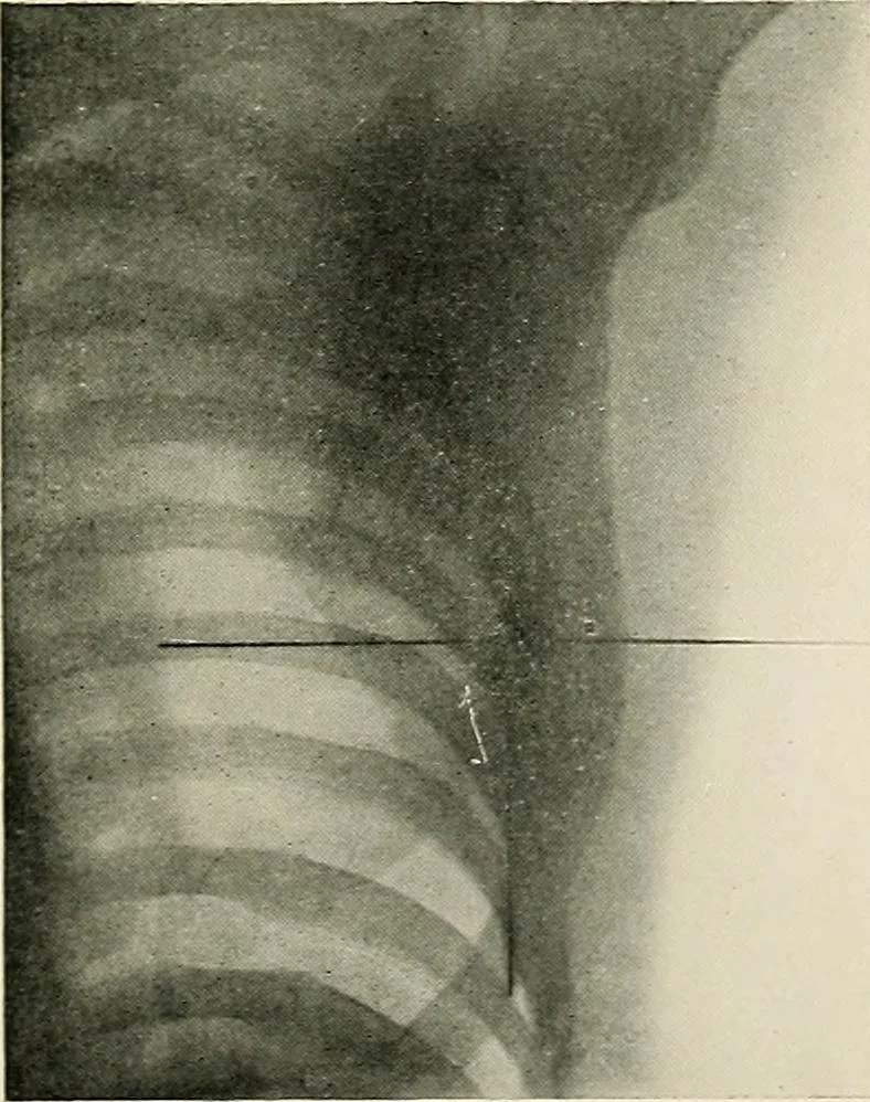 An illustration from Localization by X-rays and stereoscopy, 1916, leaf 126